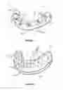 Fig. 04 - Dental implant framework