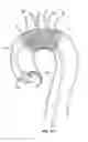 Fig. 06 - Embolic protection device