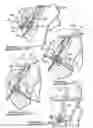 Fig. 03 - Apparatus And Method For Tibial Fixation Of Soft Tissue