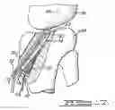 Fig. 08 - Apparatus And Method For Tibial Fixation Of Soft Tissue