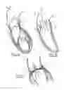 Fig. 02 - Collapsible prosthetic valve