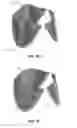 Fig. 16 - Replacement heart valves and their methods of use and manufacture