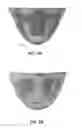 Fig. 20 - Replacement heart valves and their methods of use and manufacture
