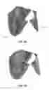 Fig. 16 - Replacement heart valves and their methods of use and manufacture