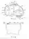 Fig. 10 - Motion facilitating tibial components for a knee prosthesis