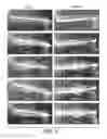 Fig. 04 - Methods For Bone Treatment By Modulating An Arachidonic Acid Metabolic or Signaling Pathway