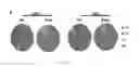 Fig. 04 - Use of Post-Transplant Cyclophosphamide Treated Allogeneic Marrow Infiltrating Lymphocytes to Augment Anti-Tumor Immunity