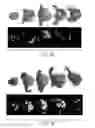 Fig. 04 - METHODS FOR PERFORMING A CORONARY ARTERY BYPASS GRAFT PROCEDURE