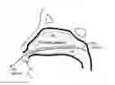 Fig. 01 - Toroidal balloon for external or internal compression with unique insertion or removal