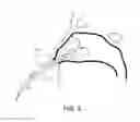 Fig. 09 - Toroidal balloon for external or internal compression with unique insertion or removal