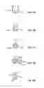 Fig. 13 - Dosimetrically customizable brachytherapy carriers and methods thereof in the treatment of tumors