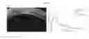 Fig. 04 - Aqueous cell differentiation in anterior uveitis using optical coherence tomography