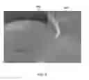 Fig. 07 - Structurally controlled deposition of silicon onto nanowires