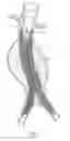 Fig. 06 - Surgical Fastener Assembly for Attaching a Prosthesis