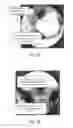 Fig. 16 - Method of performing sacroiliac fusion