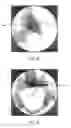 Fig. 17 - Method of performing sacroiliac fusion