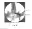 Fig. 18 - Method of performing sacroiliac fusion
