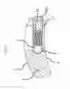 Fig. 09 - Flexible plate fixation of bone fractures