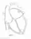 Fig. 02 - METHOD AND APPARATUS FOR RECAPTURING AN IMPLANT FROM THE LEFT ATRIAL APPENDAGE
