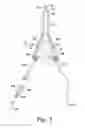 Fig. 04 - Preloaded wire for endoluminal device