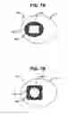 Fig. 08 - Injection zone markers for biomedical implants