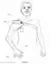 Fig. 37 - Arm prosthetic device