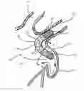 Fig. 01 - Device and method for increasing flow through the left atrial appendage
