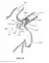 Fig. 09 - Device and method for increasing flow through the left atrial appendage