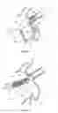 Fig. 22 - Device and method for increasing flow through the left atrial appendage
