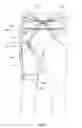 Fig. 29 - Orthopedic device for treating complications of the hip
