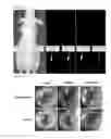 Fig. 09 - Labeling composition for cancer lesion