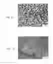 Fig. 02 - Method of reducing the risk of embolization of peripheral blood vessels