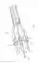 Fig. 02 - Thoracoscopic electroporation device with a suction head and with needle electrodes