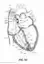 Fig. 20 - System and method for rate modulated cardiac therapy utilizing a temperature senor