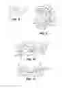 Fig. 05 - Adaptive mouth guard and method of use