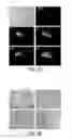 Fig. 02 - Identification of a 5-Gene Expression Signature Predicting Clinical Outcome of Patients with Brain Tumors