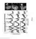 Fig. 37 - Methods related to real-time cancer diagnostics at endoscopy utilizing fiber-optic Raman spectroscopy