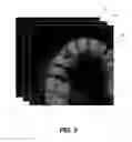 Fig. 03 - Method for teeth segmentation and alignment detection in CBCT volume