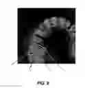 Fig. 16 - Method for teeth segmentation and alignment detection in CBCT volume