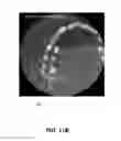 Fig. 19 - Method for teeth segmentation and alignment detection in CBCT volume