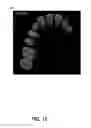 Fig. 23 - Method for teeth segmentation and alignment detection in CBCT volume