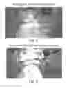 Fig. 03 - Retractor/stabilizer for excessive and/or redundant tissue and method of use