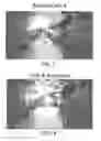 Fig. 04 - Retractor/stabilizer for excessive and/or redundant tissue and method of use