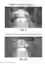 Fig. 06 - Retractor/stabilizer for excessive and/or redundant tissue and method of use