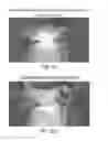 Fig. 07 - Retractor/stabilizer for excessive and/or redundant tissue and method of use