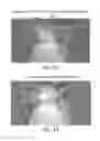 Fig. 08 - Retractor/stabilizer for excessive and/or redundant tissue and method of use