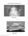 Fig. 09 - Retractor/stabilizer for excessive and/or redundant tissue and method of use