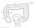 Fig. 01 - Endoluminal device with retractor system