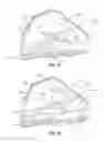 Fig. 06 - Endoluminal device with retractor system