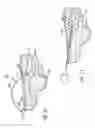 Fig. 06 - Apparatus for and method of providing a hip replacement